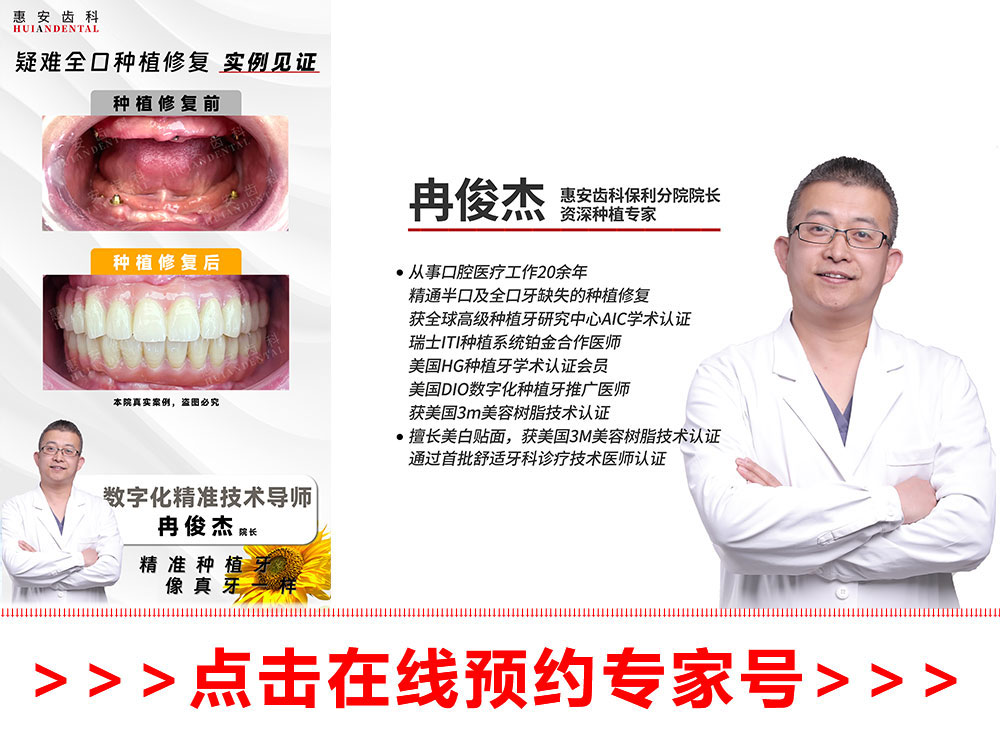 兰州惠安齿科医生，兰州惠安齿科种植专家，兰州惠安齿科种植医生，兰州种植牙医生
