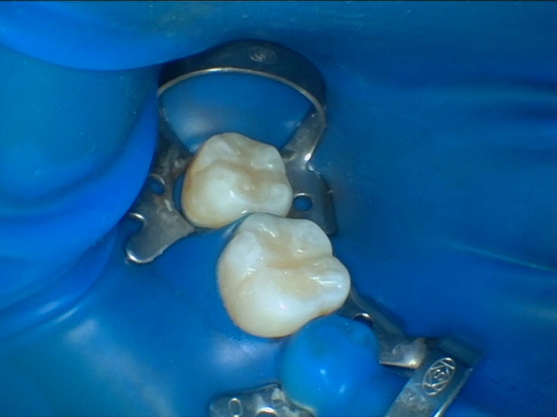 兰州牙科,兰州口腔,兰州根管,兰州根管推荐,兰州根管治疗,兰州根管哪家好